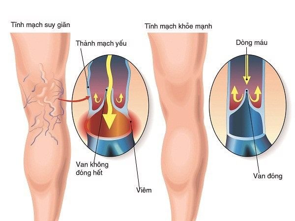 Hỗ trợ trị giãn tĩnh mạch Caruso's Veins Clear Của Úc 60 viên – Hàng Úc Thom Dang